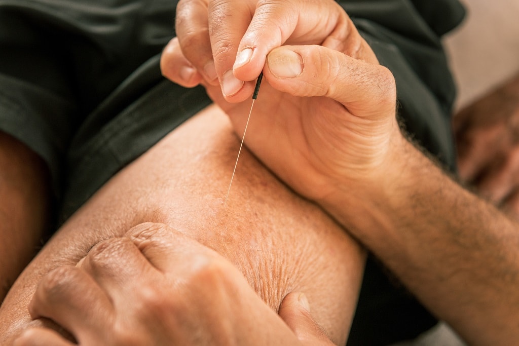 Physio DST Dry Needling